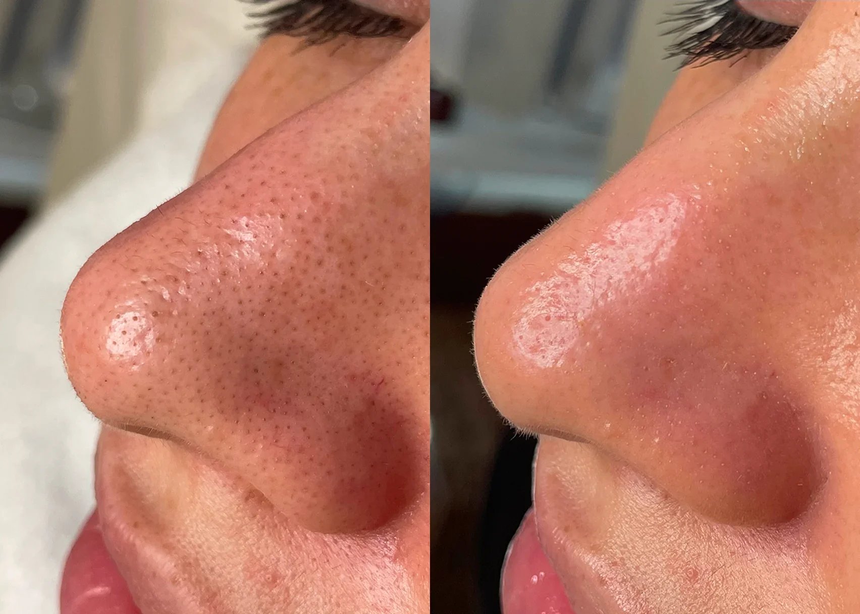 Glo2 Facial before and after — cleared clogged pores and improved skin clarity at Below Zero Spa Victor NY