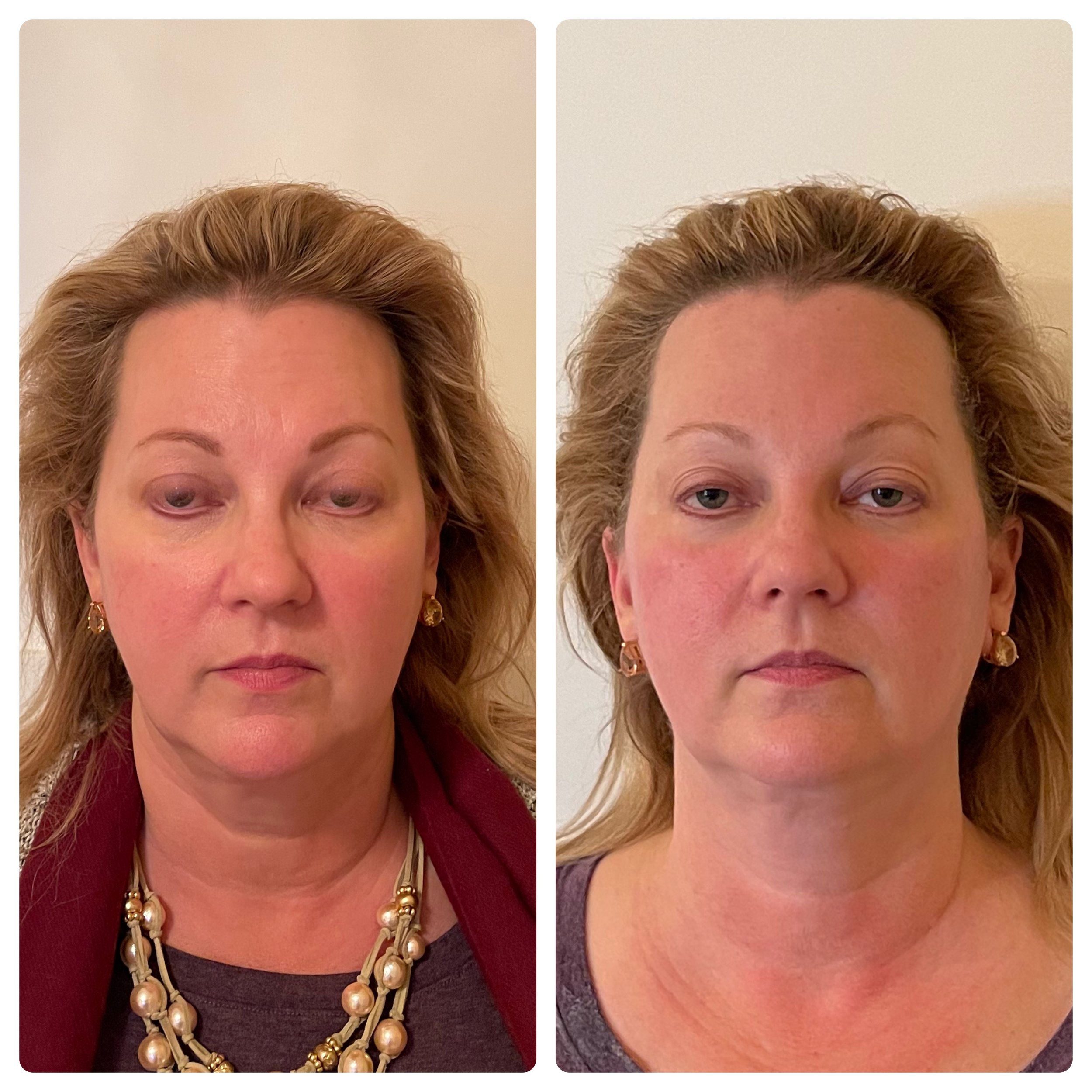 Natural Facelift before and after — visibly lifted, sculpted appearance without surgery at Below Zero Spa Victor NY