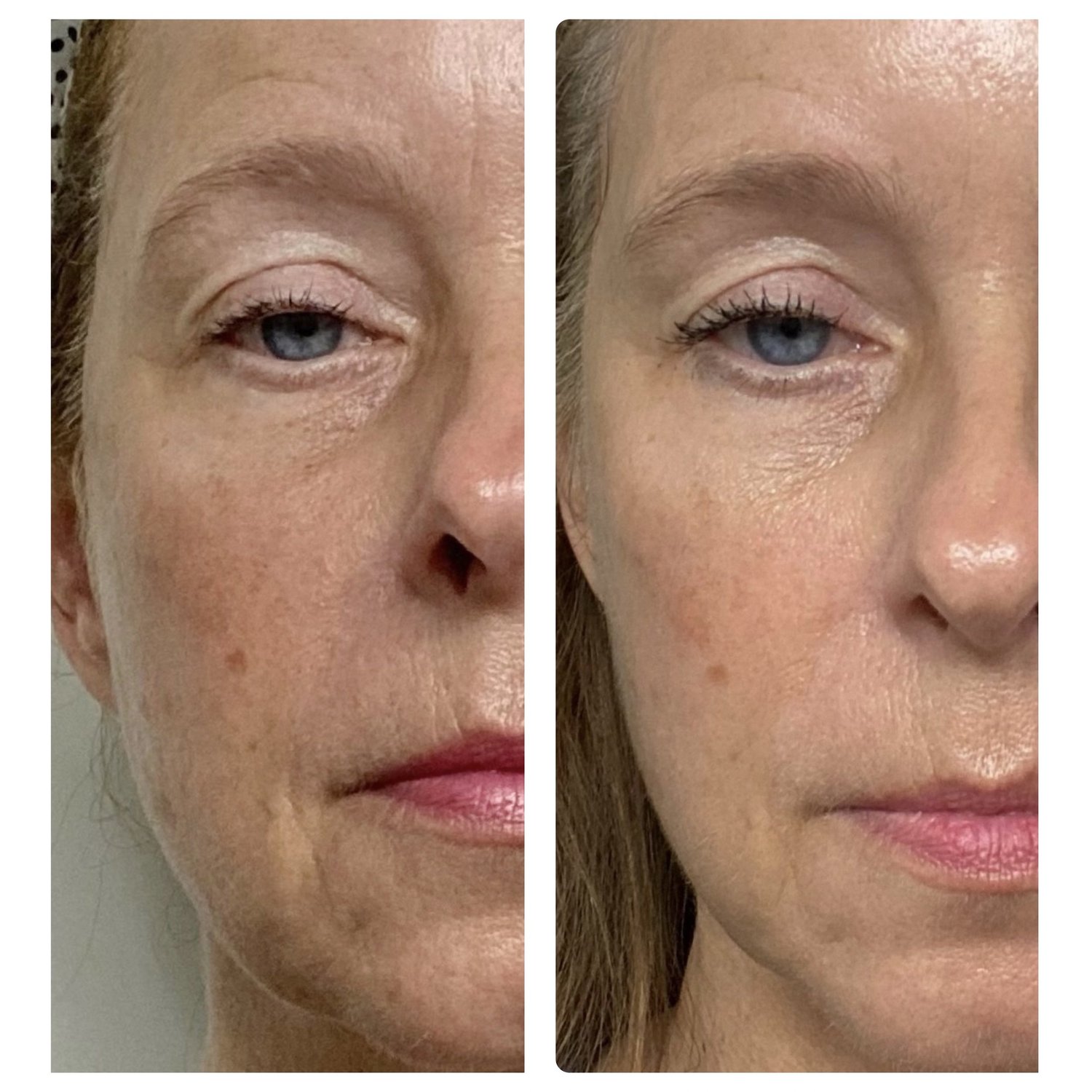 Red Light Therapy Facial before and after — improved skin texture and brightness after a single non-surgical treatment at Below Zero Spa