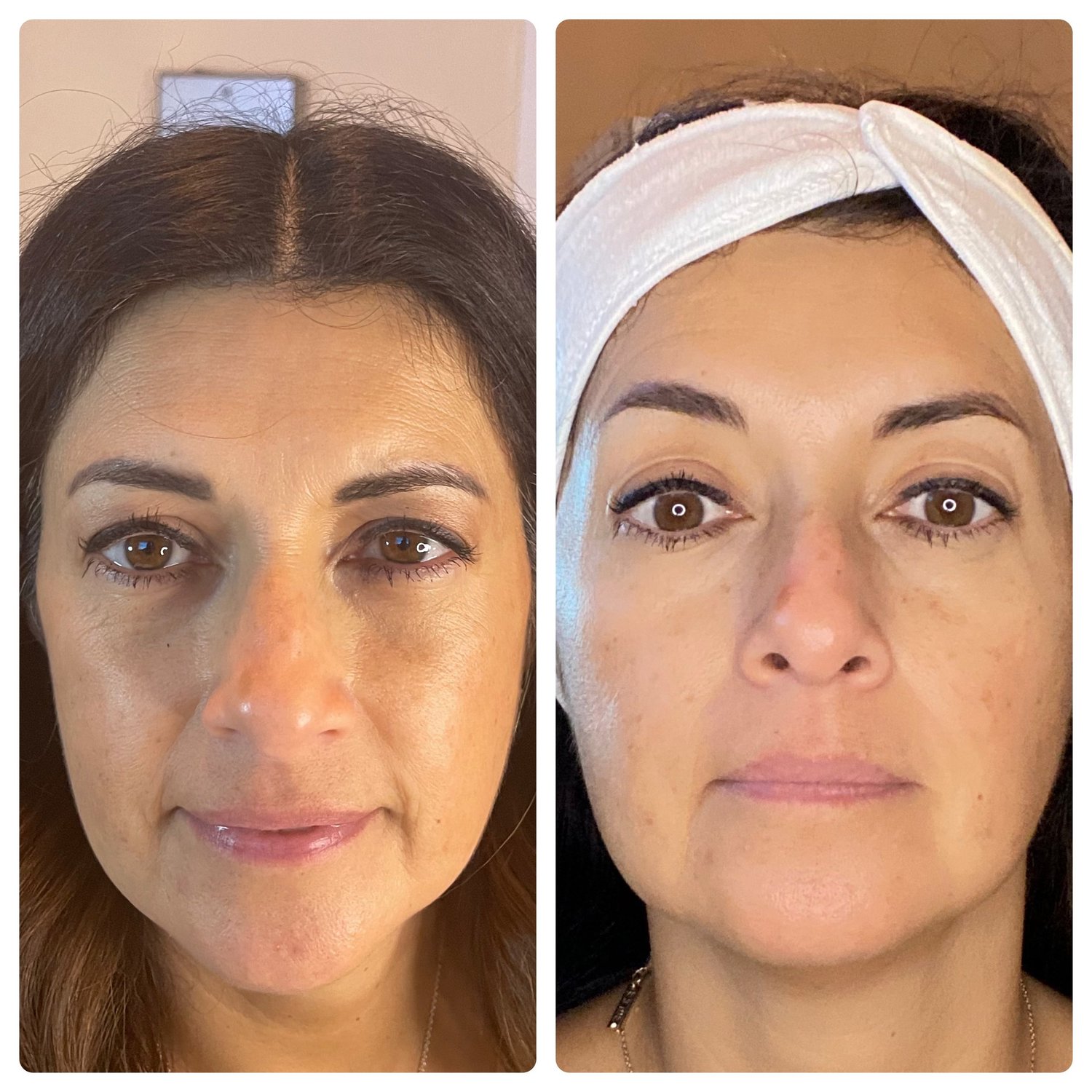 Quick Non-Surgical Lifting Facial before and after — visibly tighter, lifted appearance without needles at Below Zero Spa