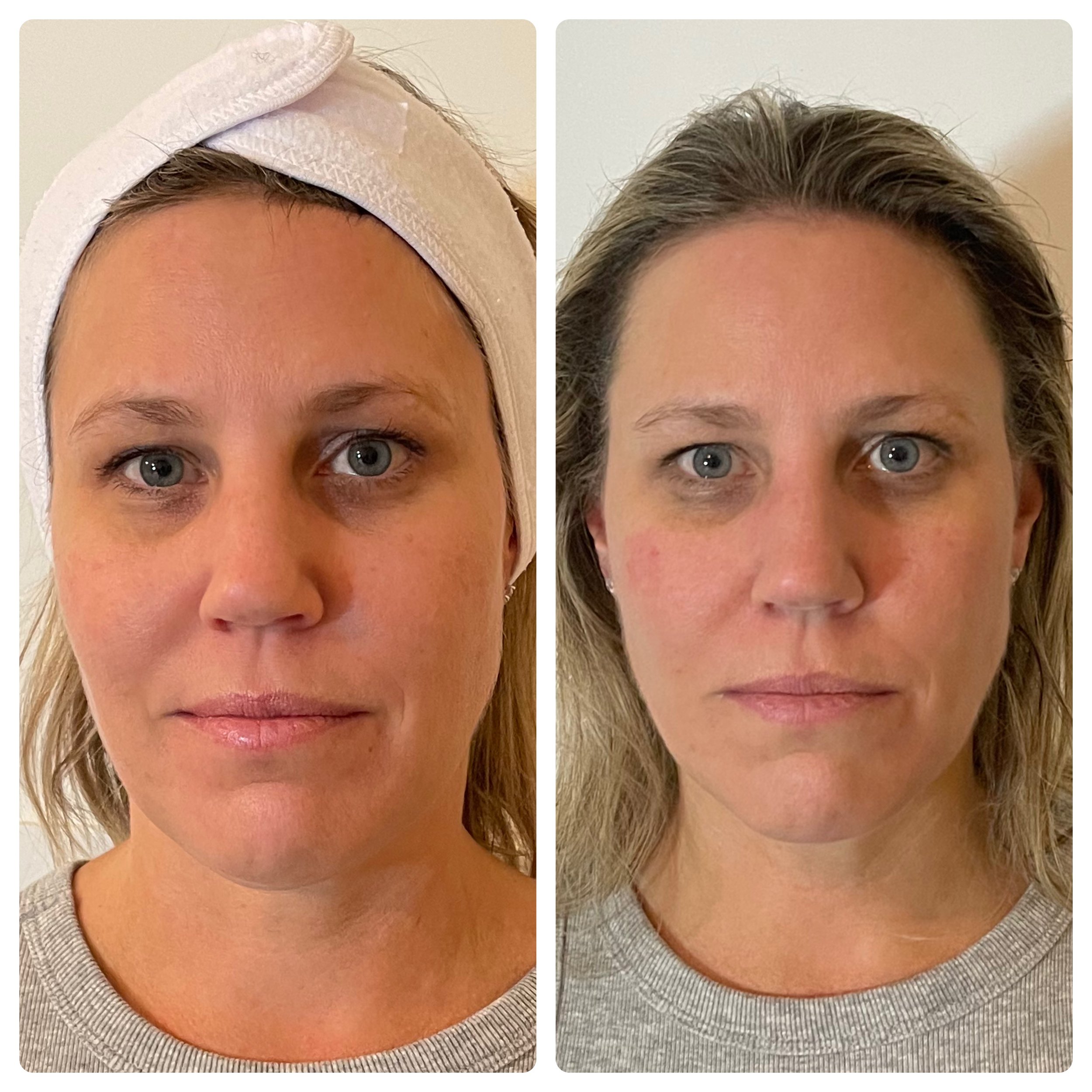 Natural Facelift before and after — refined, rejuvenated skin without surgery at Below Zero Spa Victor NY